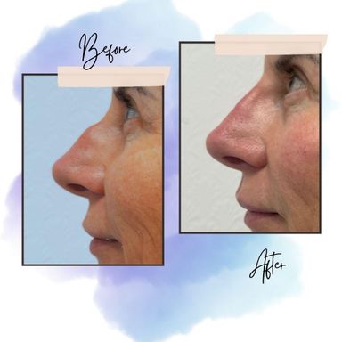 Non-surgical Rhinoplasty