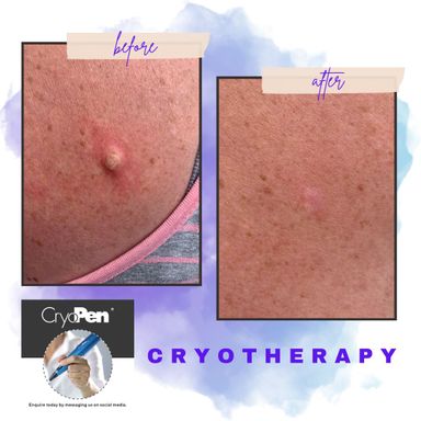 Cryotherapy Skin Lesion Removal