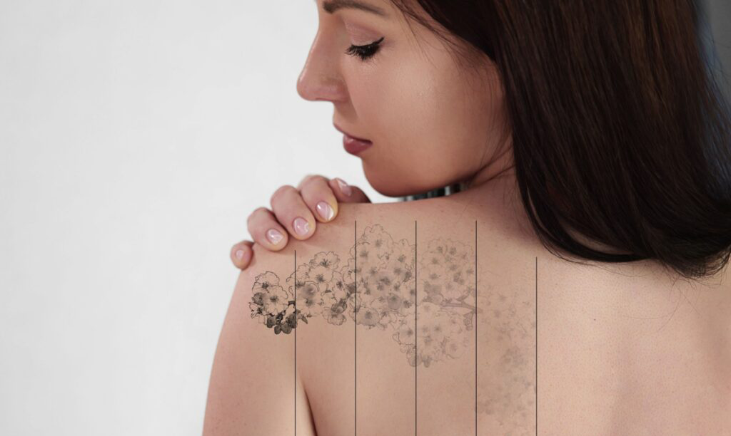 ⁠Laser Tattoo Removal